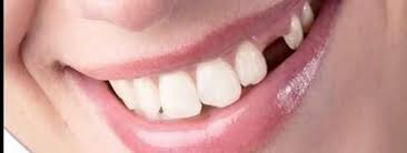 فقدان الأسنان الأمامية وكيفية تعويضها - DentCenterTurkey