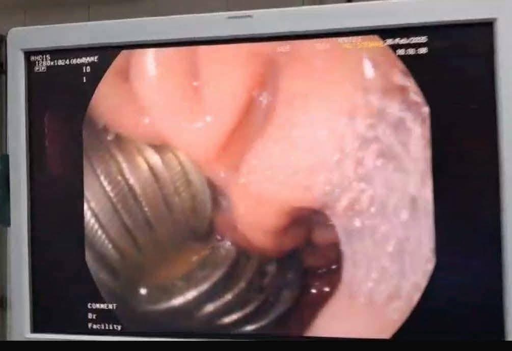 كواليس استخراج 13 جنيه من بطن طفل بمستشفى جامعة المنصورة