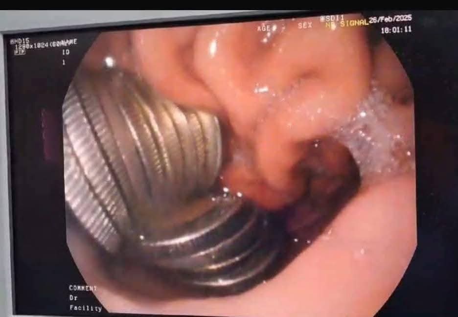 كواليس استخراج 13 جنيه من بطن طفل بمستشفى جامعة المنصورة
