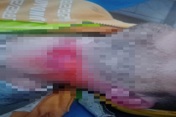 جرح ذبحي في رقبة المجني عليه الثاني