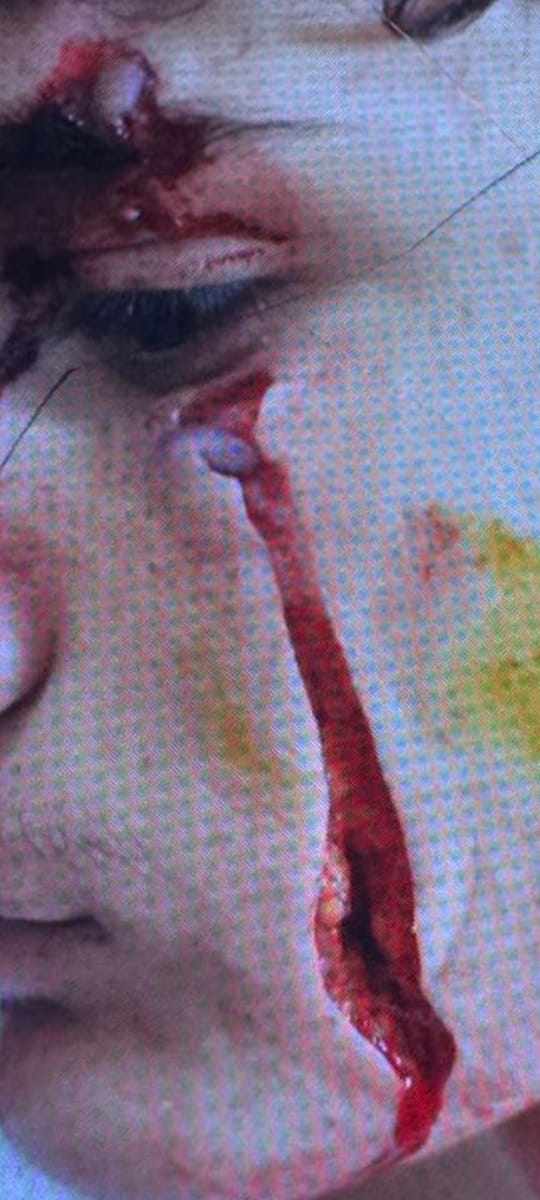 إصابة عميقة في وجه الطالب قبل إجراء “الغرز”