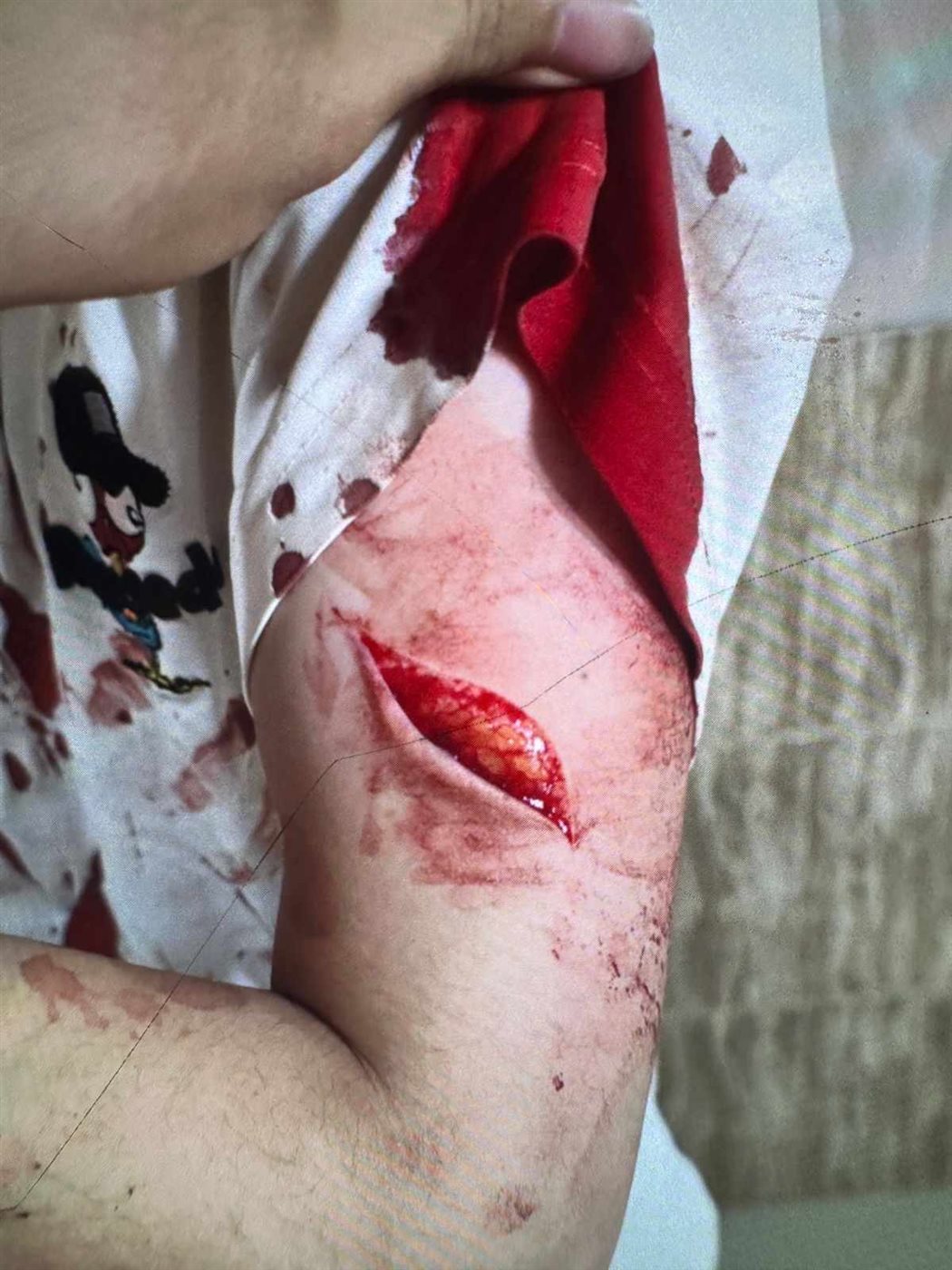 وإصابة عميقة أخرى في ذراع المجني عليه