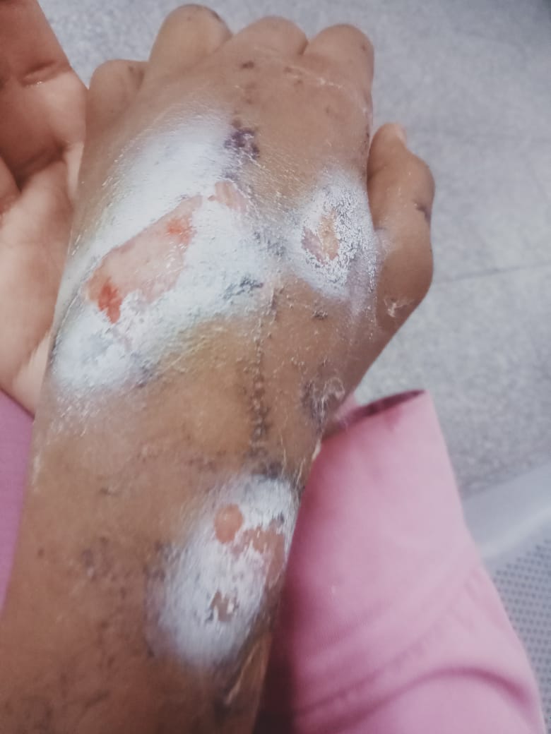 التهاب الجرح بعد العودة وإعادة الجبس مره اخري