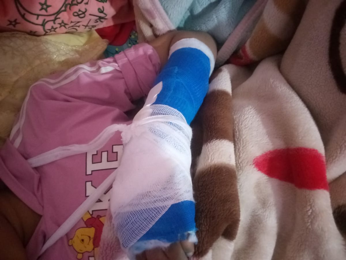 بعد عمل الحبس وتعقيم الجرح