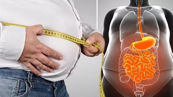 تراكم الدهون