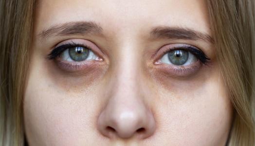 &nbsp;الهالات السوداء&nbsp;