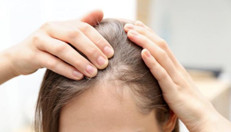 مرض الثعلبة