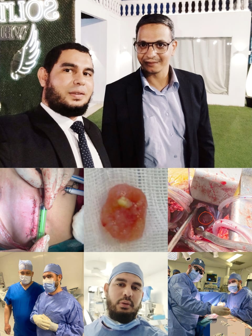فريق طبي بمستشفى الحسين ينقذ حياة شاب باستئصال ورم نادر من القلب
