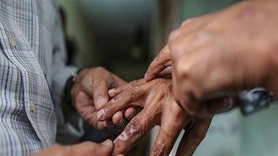 استشاري جلدية: مرض الجذام ينجم عن ميكروب بكتيري يصيب الجلد