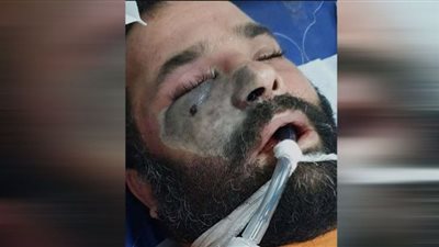 يتسبب في إزالة أنف أو عين أو فك المريض | كل ما تريد معرفته عن مرض 
