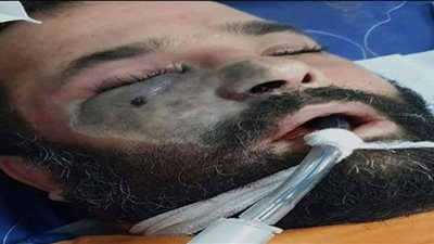 (فيديو)الاستهتار بكورونا| أستاذ مناعة يكشف أسباب انتشار الفطر الأسود