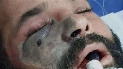 فيديو.. استشاري مناعة يكشف سبب زيادة الإصابة بالفطر الأسود في الفترة الحالية