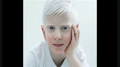في اليوم العالمي للمهق.. 5 أفلام عالمية تدعم أبناء الشمس