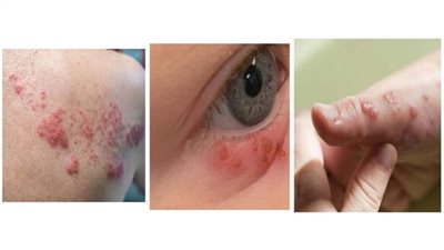 يصيب الكبار والصغار.. تعرف على فيروس الهربس وأعراضه ( تفاصيل )