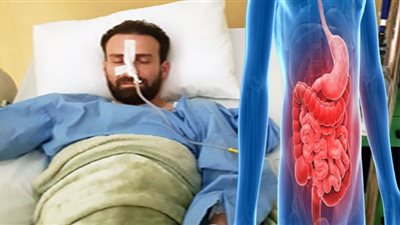 بعد خضوع نضال الشافعي إلى عملية جراحية.. أسباب انفجار القولون وطرق العلاج