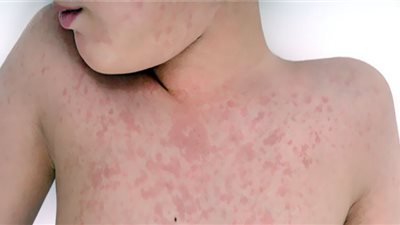 أنواع الطفح الجلدي وأخطاره