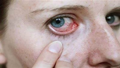 من الحكة إلى الاحمرار.. 5 أعراض للإصابة بفيروس كورونا من الأعين