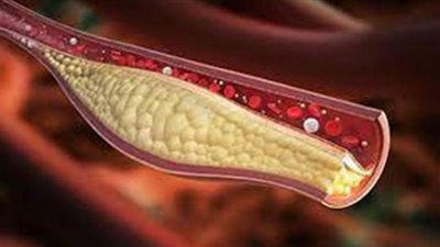 الكوليسترول متهم بالوقوف وراء الإصابة بالسرطان