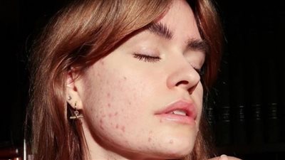 وداعا للإحراج.. 5 أطعمة تحميك من ظهور حب الشباب لا تعرفها من قبل