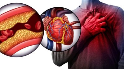 أعراض ارتفاع نسبة الكوليسترول بالدم| نصائح للحفاظ على معدلاته