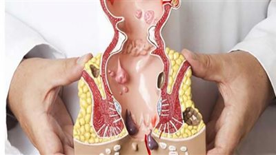 5 علاجات منزلية سريعة للتخلص من البواسير