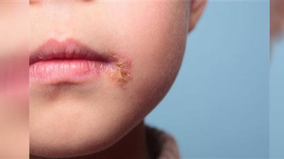 إنفوجراف| الصحة تكشف أعراض فيروس الهربس الفموي