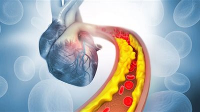3 طرق تساعد على قتل الكوليسترول في الجسم