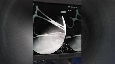نجاح اول عملية تثبيت خلع بمفصل الكتف بتقنية جديدة بدكرنس العام