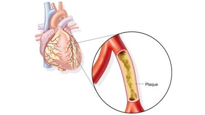 ما أعراض أمراض الشريان التاجي؟