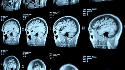 تحدث بسبب تصلب الشرايين.. أسباب السكتة الدماغية وأعراضها