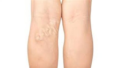 أفضل الأطعمة لعلاج دوالي الساقين (تفاصيل)