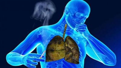 إنفوجراف.. أسباب الانسداد الرئوي المزمن