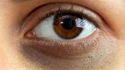 أنواع الهالات السوداء وعلاجها