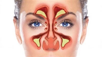 دراسة: الجيوب الأنفية تؤثر على الدماغ وتسبب مشكلات خطيرة
