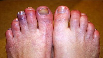 أحدث صيحة لأعراض الفيروس| أصابع كورونا تصيب الأطفال والمراهقين