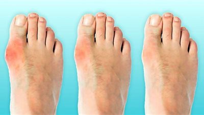 دراسة صادمة: تورم إصبع القدم من علامات الإصابة بفيروس كورونا
