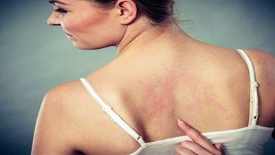 احذر.. 4 علامات لتجلط الدم يجب ألا تتجاهلها على الإطلاق