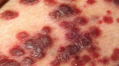 90 مليون دولار لمكافحة الإيدز‎‎ في ناميبيا