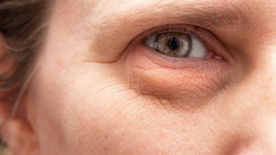 طرق طبيعية للتخلص من الانتفاخ تحت العينين