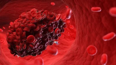 مواد غذائية ترفع خطر الإصابة بتجلطات الدم (تجنبها)