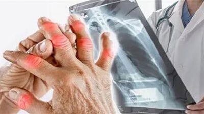 احذر.. علامات في الأصابع والوجه والرقبة تؤكد إصابتك بسرطان الرئة