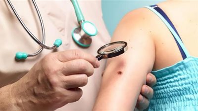 لن تتوقع.. هؤلاء أكثر عُرضة للإصابة بسرطان الجلد