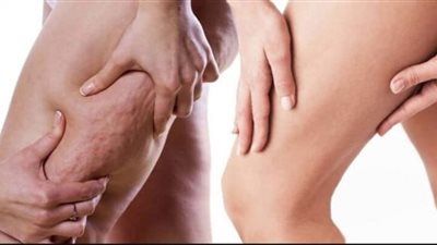 بهذه العادات اليومية.. تخلصي من السيلوليت وتألقي بأنوثتك