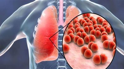في اليوم العالمي للسُل.. تعرف على بداية ظهوره وأعراضه والوقاية منه