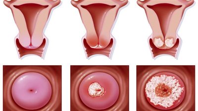 سرطان عنق الرحم.. لا ينتقل بالوراثه وسببه فيروسي (التفاصيل من هنا)