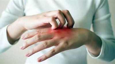 اكتشاف أعراض جلدية خطيرة تظهر مع الإصابة بكورونا