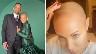 استشاري أمراض جلدية: حالة زوجة ويل سميث تسبب ضغطًا نفسيًا رهيبًا على أسرتها