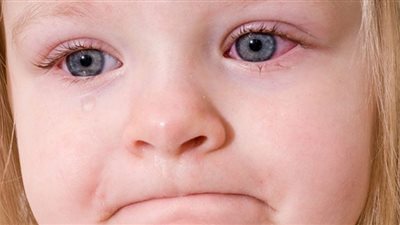 (فيديوجراف) أسباب احمرار العيون لدى الأطفال.. أبرزها انسداد القناة الدمعية