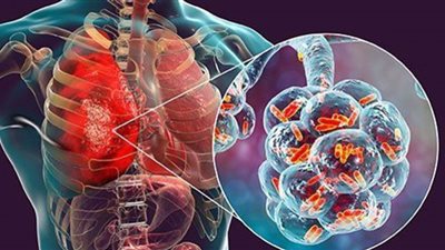 أعراض الالتهاب الرئوي وطرق وقاية الأطفال (إنفوجراف)