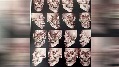 جراحة ناجحة لتثبيت الفك وإعادة تطابق الأسنان لمريض بمستشفى بنى سويف التخصصي